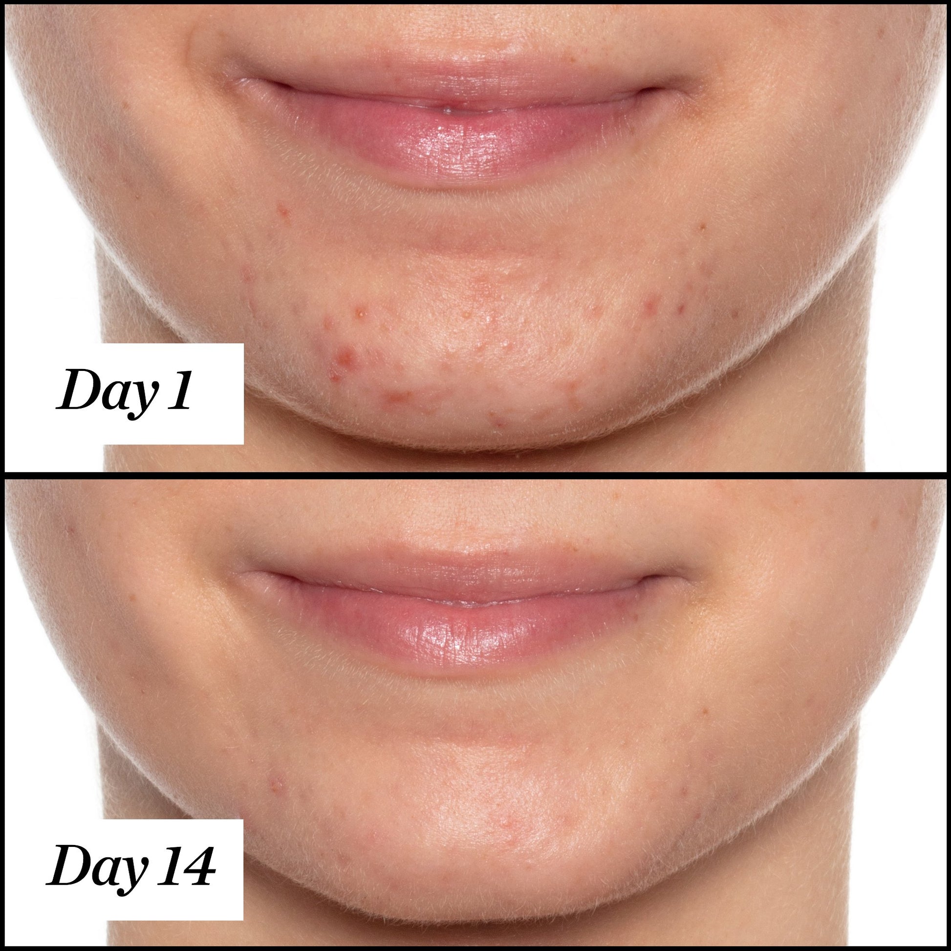 U.F.O. product usage, before and after results from day 1 to day 14. Clear and visible results; reduced redness and blemishes.
