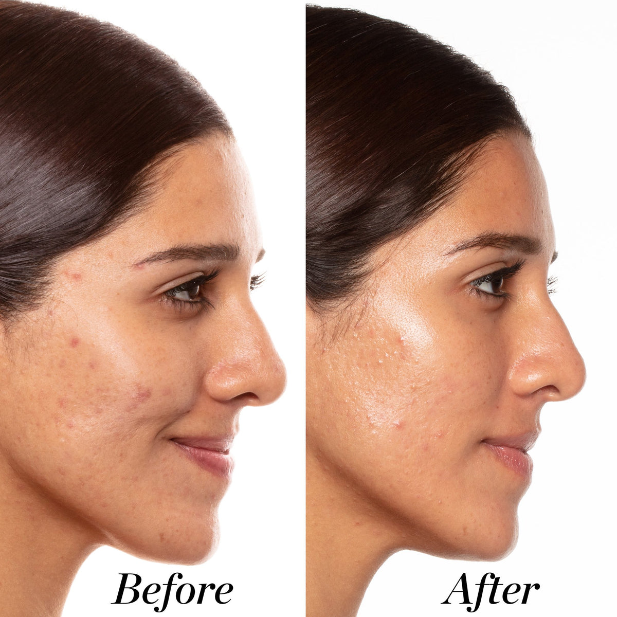 Before and after image of female who used A+ for 6 weeks